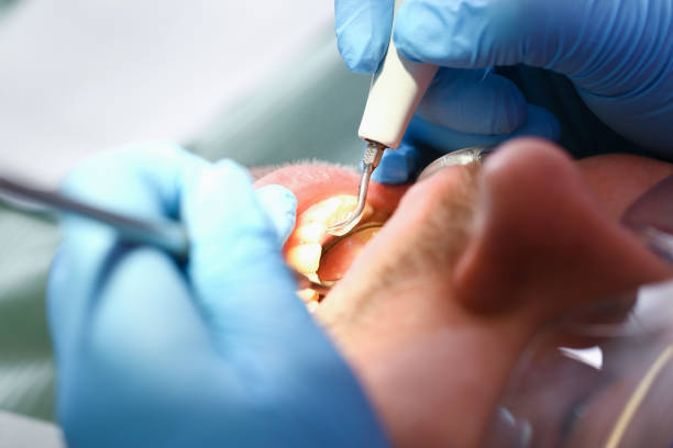 Best Emergency Root Canal Treatment in Southern View, IL